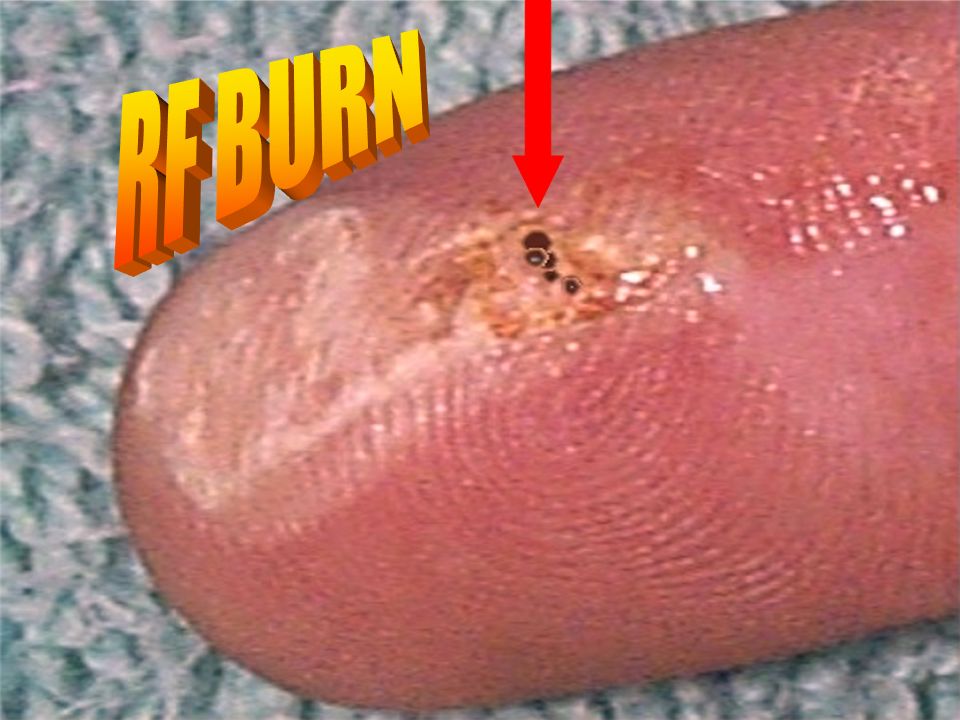 RF BURN